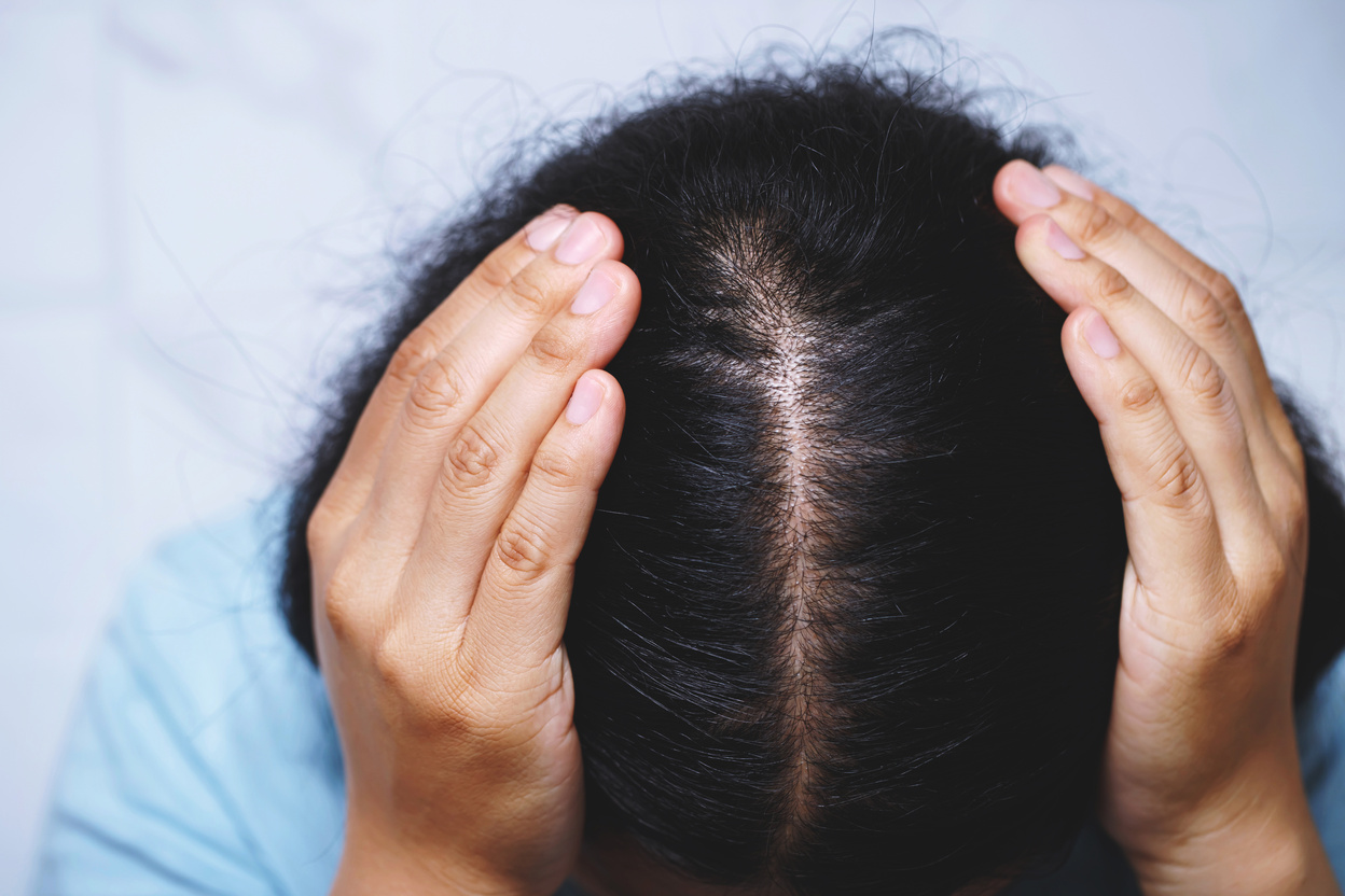 Woman Experiencing Hair Loss 